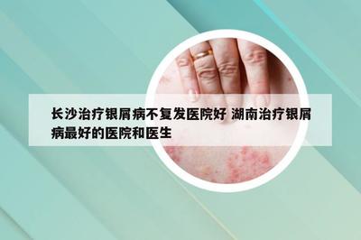 长沙及湖南地区银屑病治疗与预防指南