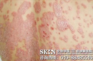 银屑病的病因与预防措施