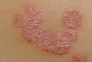 男性银屑病预防指南与咨询建议