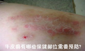银屑病预防保健 哪些部位需要重点关注