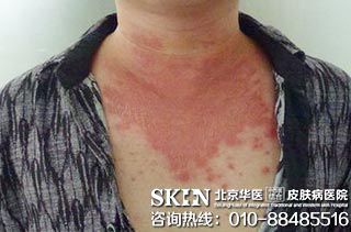 银屑病科学预防与日常管理指南