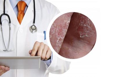 女性银屑病患者生活指南 日常禁忌与科学预防咨询